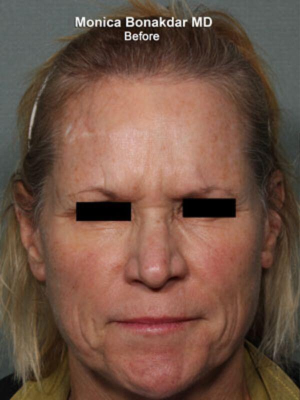 Botox Cosmetic Before & After Photo