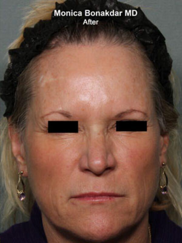 Botox Cosmetic Before & After Photo