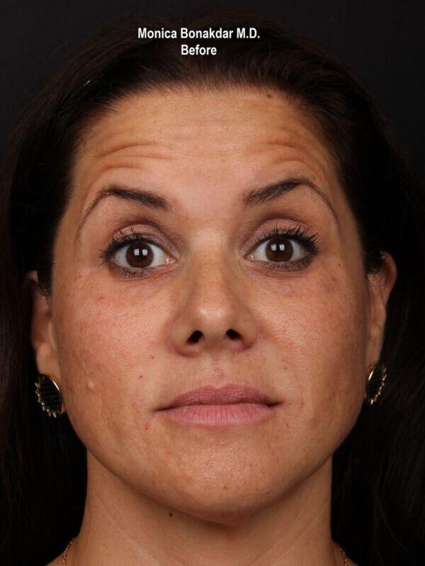 Botox Cosmetic Before & After Photo