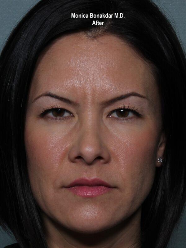 Botox Cosmetic Before & After Photo