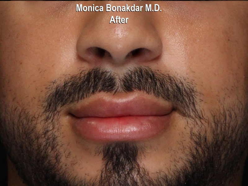 Dramatic Lip Enhancement Before & After Photo