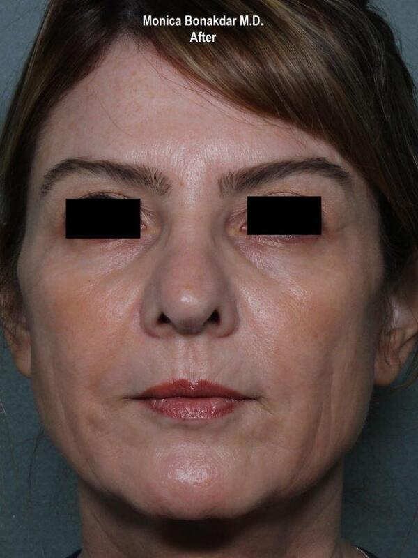 Lower Face and Jaw Contour Before & After Photo