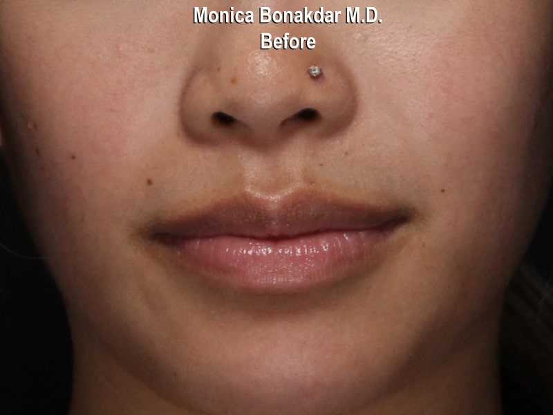 Moderate Lip Enhancement Before & After Photo