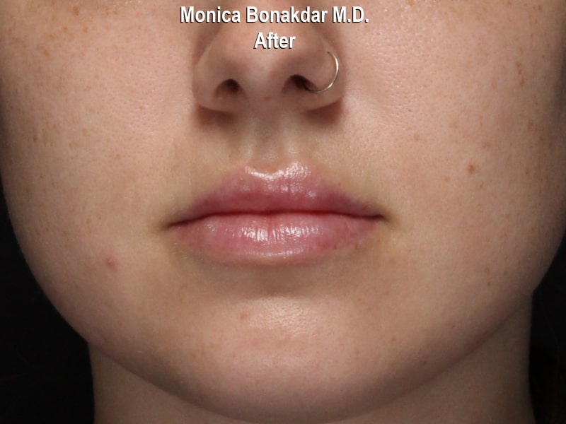 Moderate Lip Enhancement Before & After Photo