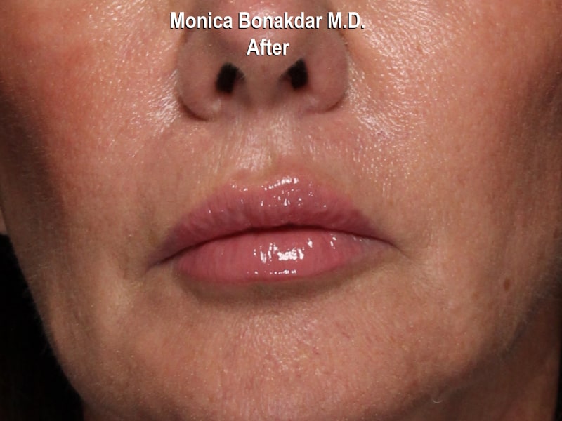 Lips: Natural Lip Enhancement Before & After Photo