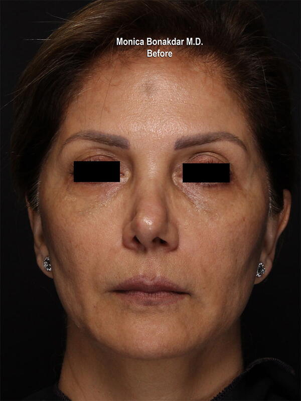 Sunken Eyes: Moderate Before & After Photo