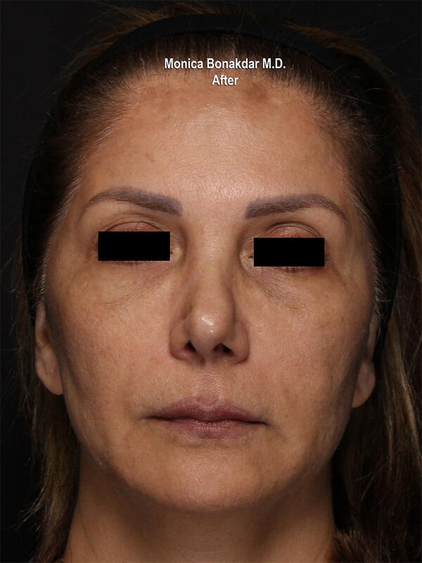 Sunken Eyes: Moderate Before & After Photo