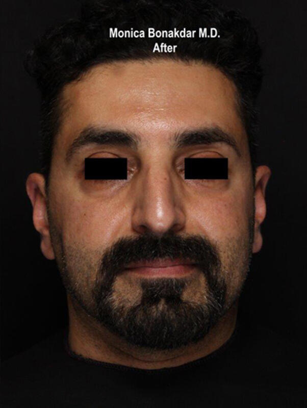 Before And After Upper Face And Temples Procedures In Newport Beach Ca Bonakdar Aesthetics